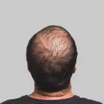PRP for Hair Loss