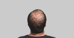 PRP for Hair Loss