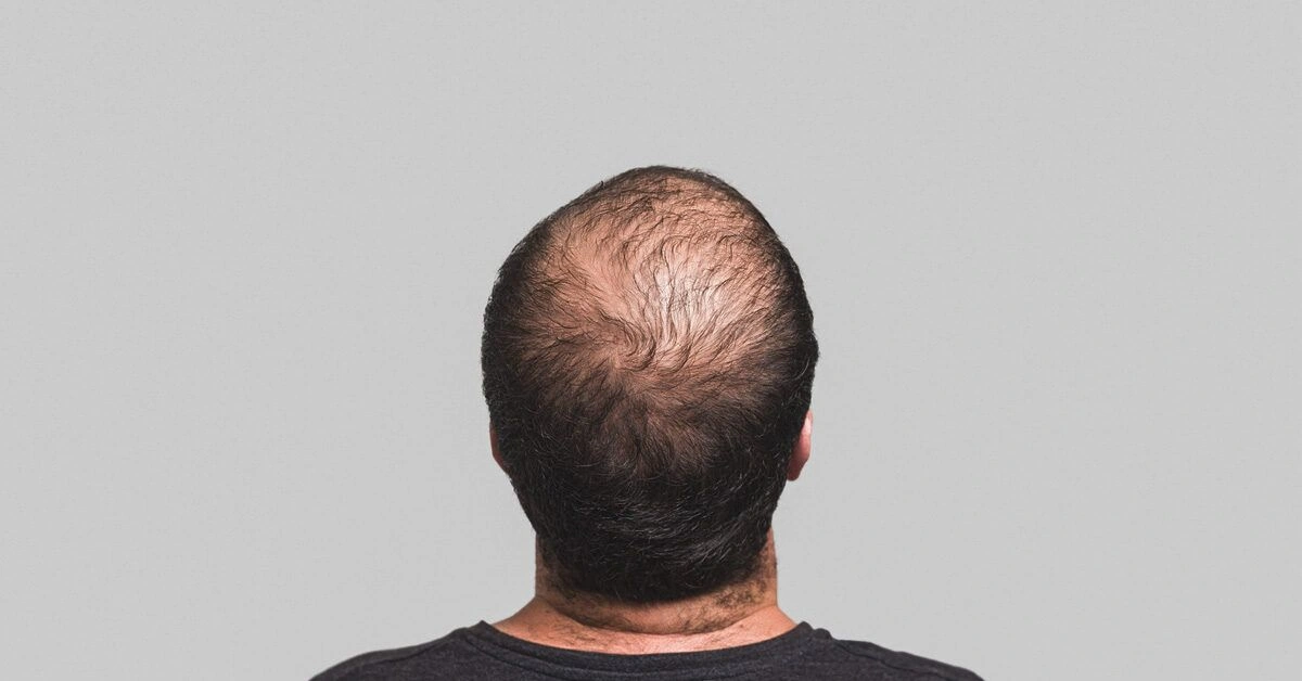 PRP for Hair Loss