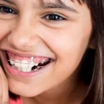 What to Know Before You Get a Retainer What to Know Before You Get a Retainer