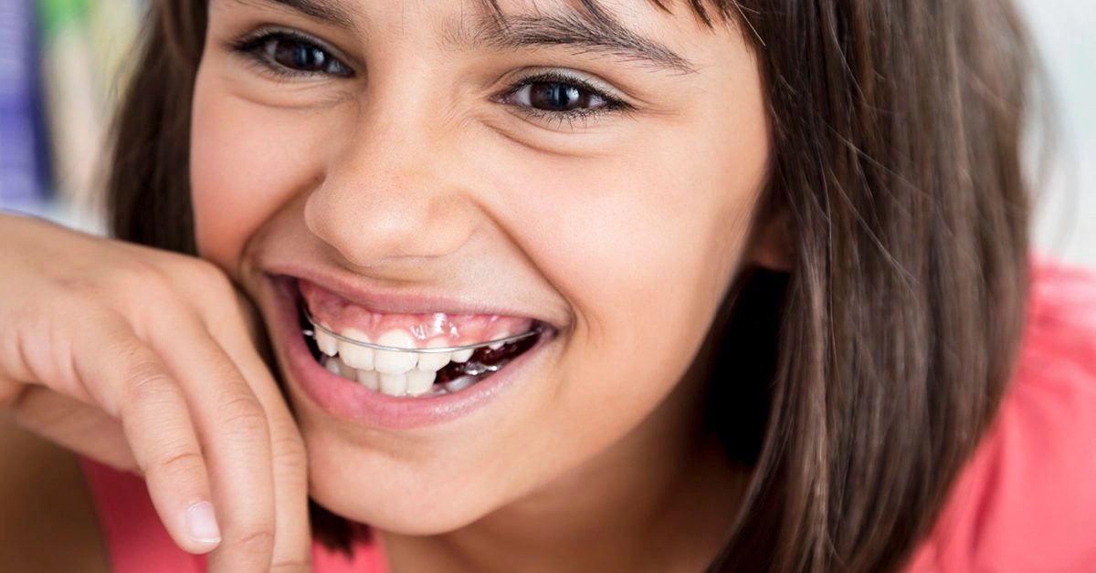 What to Know Before You Get a Retainer
