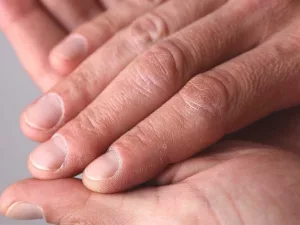 Why Do I Have Ridges in My Fingernails? Why Do I Have Ridges in My Fingernails?