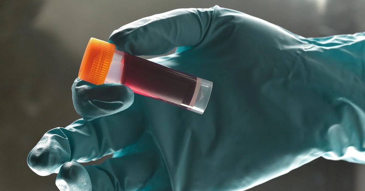 What Is Serum Cholesterol and Why Is It Important?