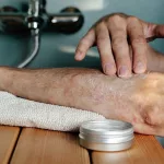 Shingles Vs Eczema: Signs, Symptoms, Differences