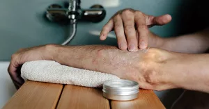 Shingles vs Eczema: How To Tell the Difference Between Them Shingles vs Eczema: How To Tell the Difference Between Them