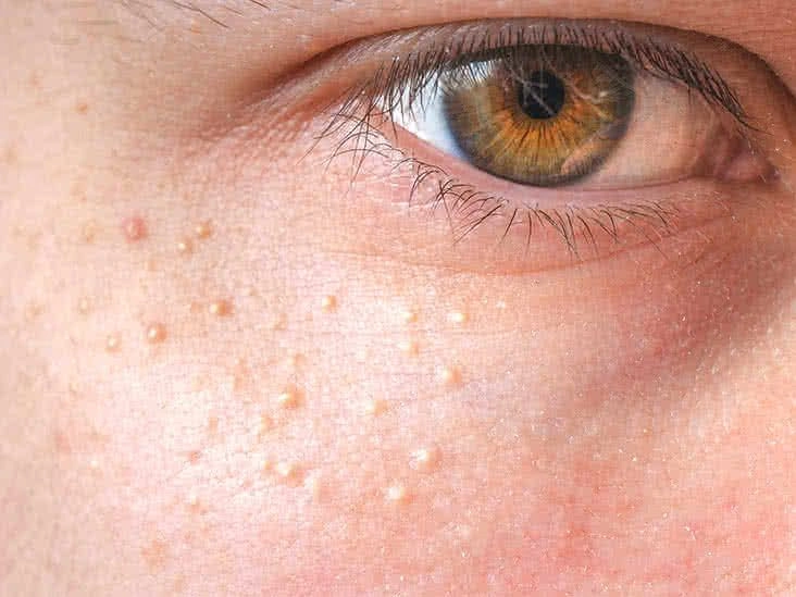 7 Safe Home Remedies for Removing Milia