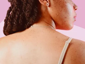 Skin Tag Removal Options