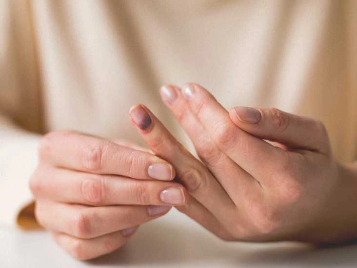 Treatment and Recovery for a Smashed Finger