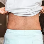 Subacute Cutaneous Lupus — Symptoms & Care