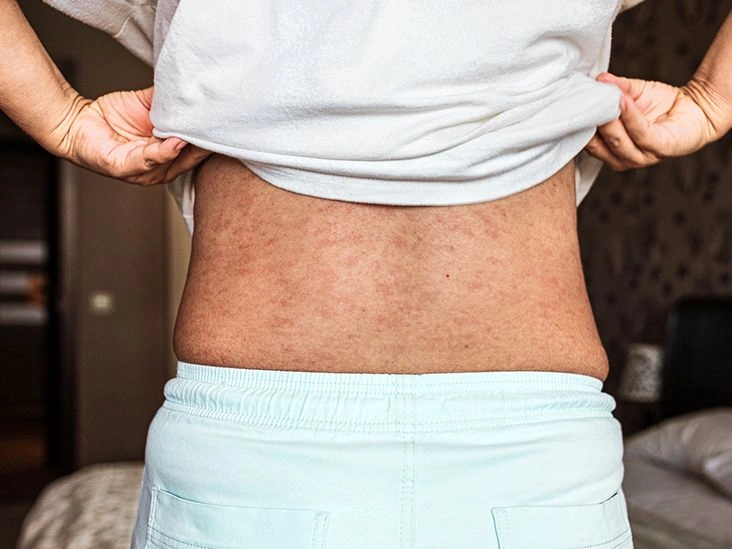 Subacute Cutaneous Lupus — Symptoms & Care