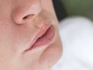 6 Causes of Swollen Lips 6 Causes of Swollen Lips