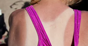 How to Identify a Tanning Bed Rash