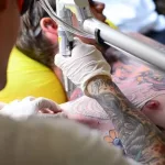 Everything You Need to Know About Tattoo Removal