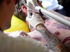 Everything You Need to Know About Tattoo Removal Everything You Need to Know About Tattoo Removal