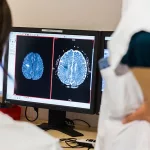 What Is a Thrombotic Stroke?