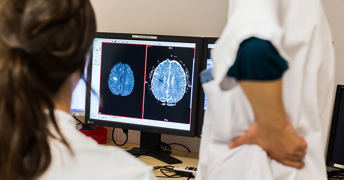 What Is a Thrombotic Stroke?