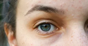 What Are Triple Eyelids, and Can They Be Treated?