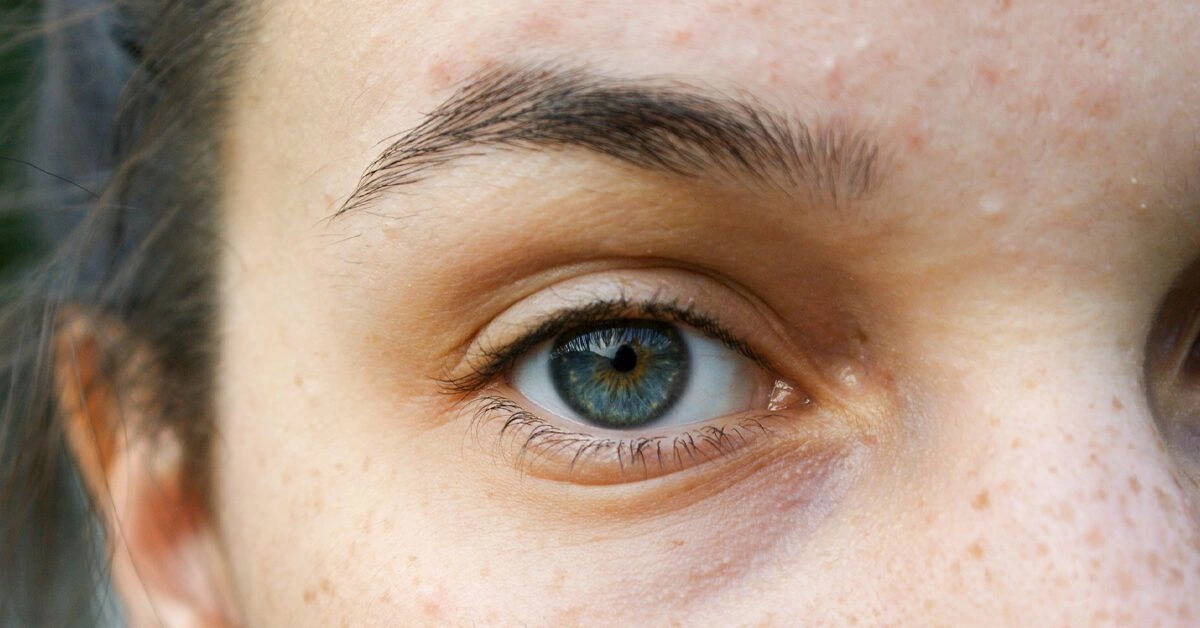 What Are Triple Eyelids, and Can They Be Treated?