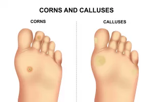 What Does a Corn Look Like? Real Talk About Bumps on Your Feet