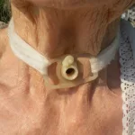 What Is a Tracheostomy Collar?