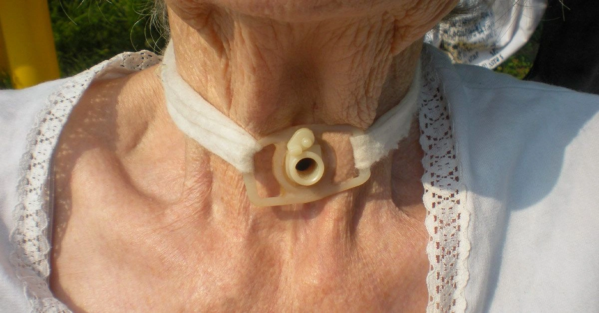 What Is a Tracheostomy Collar?