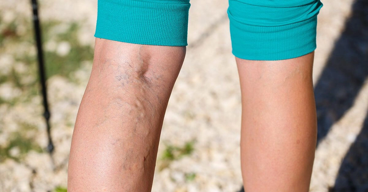 Why Are My Veins Suddenly So Visible?