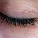 What Causes Eyelash Pain? What Causes Eyelash Pain?