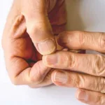 Spoon Nails (Koilonychia)