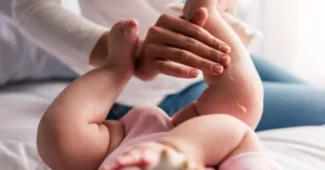 Can Scabies Be Treated with Over-the-Counter Products?