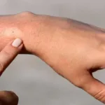 Identifying Bug Bites and Stings, and How to Treat Them