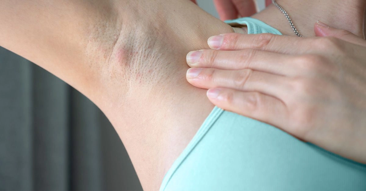 Are Itchy Armpits a Cancer Warning Sign?