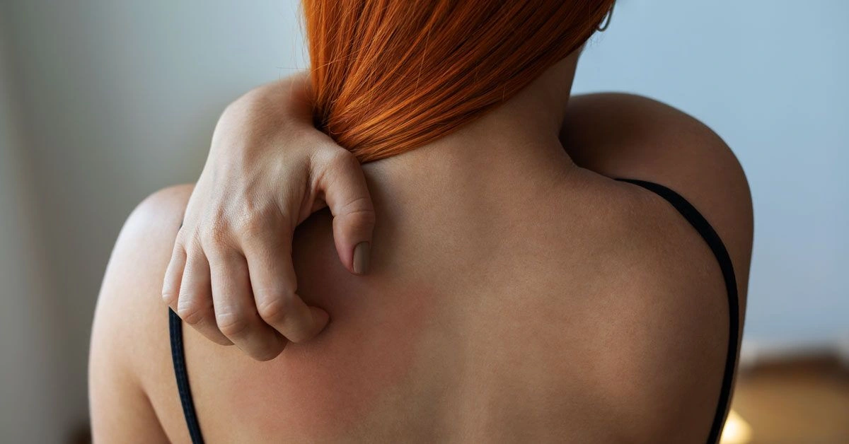 What Are the Cutaneous Stigmata (Skin Symptoms) of Cirrhosis?