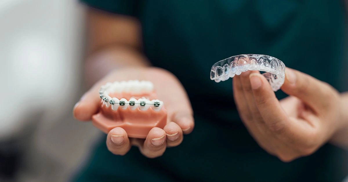 Aligners vs. Braces: Pros and Cons