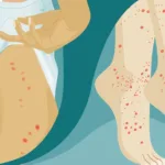 Is It a Bedbug or a Chigger Bite?