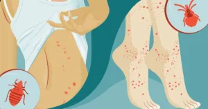 Is It a Bedbug or a Chigger Bite?