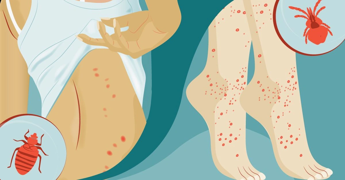 Is It a Bedbug or a Chigger Bite?