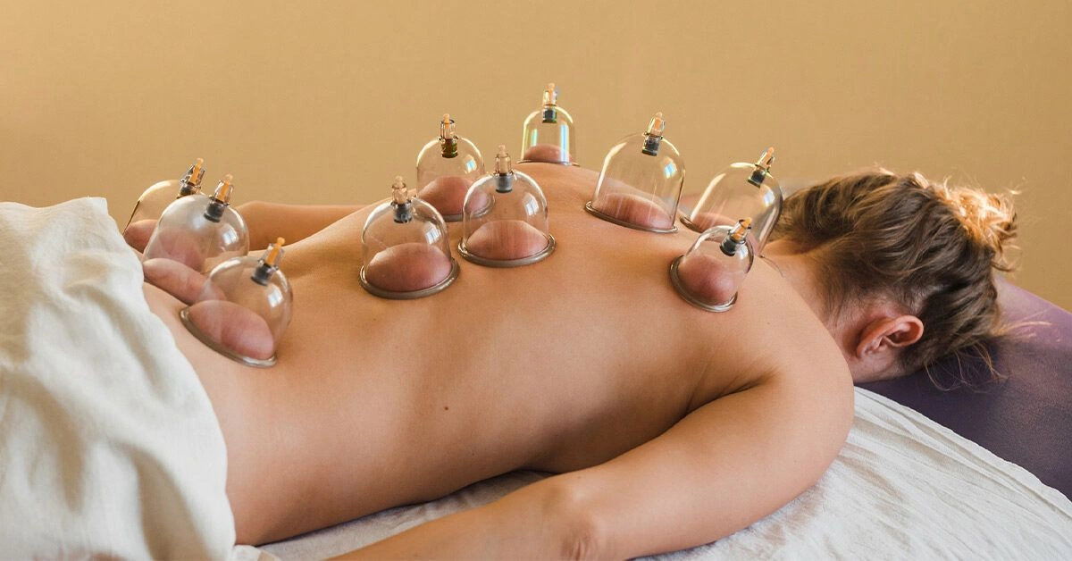 What Is Cupping Therapy?