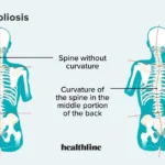 Thoracic Scoliosis: What You Need to Know