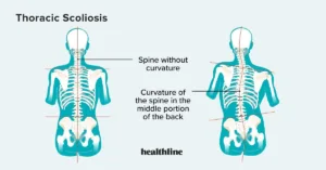 Thoracic Scoliosis: What You Need to Know
