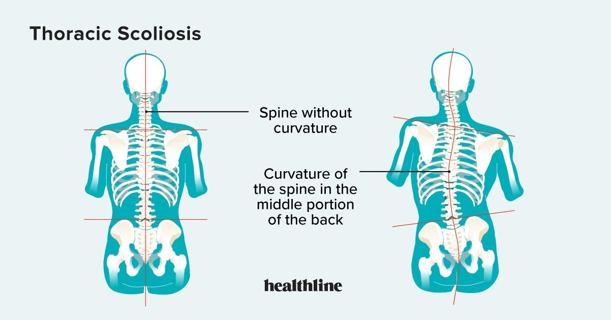 Thoracic Scoliosis: What You Need to Know