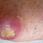 Pictures of Diabetic Neuropathy