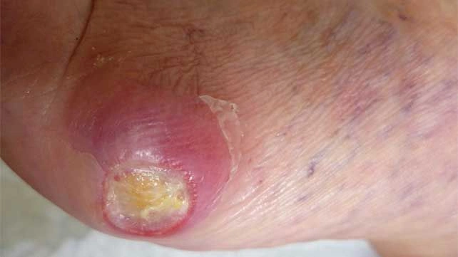 Pictures of Diabetic Neuropathy
