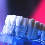 What to Know Before You Get Dental Veneers What to Know Before You Get Dental Veneers