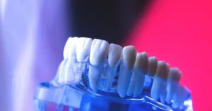 What to Know Before You Get Dental Veneers