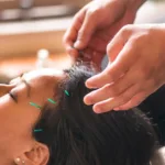 Can Acupuncture Help with Anxiety?