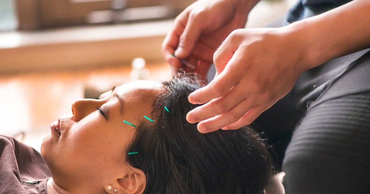 Can Acupuncture Help with Anxiety?