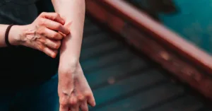 How Long Do the Symptoms of Eczema Last?