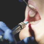 How Long Does Novocaine Last?