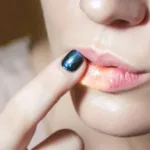 What Causes Split Lips?