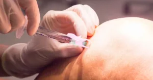 Will Medicare Cover Rooster Comb Injections?
